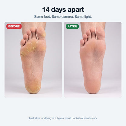 Illustrative before and after: cracked heel and smooth skin fourteen days later