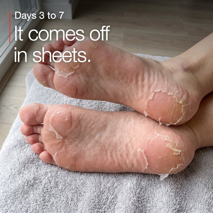 Dead skin peeling from the soles between day three and day seven